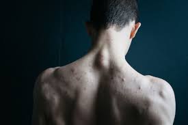 Jerawat adalah penyakit kulit yang disebabkan bakteria dan biasanya muncul pada bahagian muka, leher, belakang badan dan dada. Pria Simak 7 Cara Menghilangkan Jerawat Di Punggung Ini Bukareview