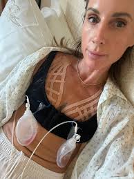 Has anyone's memory loss improved significantly after getting implants  removed?