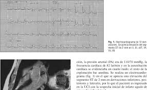 Myocardial inflammation in the absence of ischaemia. Diagnostico De Miocarditis Aguda Por Cardiorresonancia Magnetica Con Contraste Semantic Scholar
