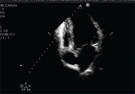 Endocarditis, myocarditis and pericarditis (systemic infection) (medical microbiology and infection). A Rare Case Of Giant Cell Myocarditis With Aortic Involvement Shukla S Acharya S Wanjari A Sancheti A Mahajan S N Ann Trop Med Public Health