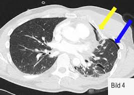 Pneumothorax Universitatsklinikum Freiburg