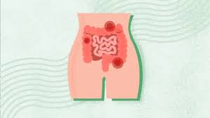 Image result for Acute Constipation