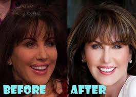 Robin Mcgraw Plastic Surgery Before And After Facelift Robin Mcgraw Plastic Surgery Plastic Surgery Celebrity Plastic Surgery