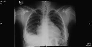 Transudative = bilateral effusions oncontic and hydrostatic pressures unbalanced. Chest X Ray Shows Cardiomegaly And Bilateral Pleural Effusion Download Scientific Diagram