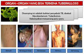 Sakit tulang merupakan sakit yang bisa dialami oleh semua orang mulai dai anak muda sampai dengan orang yang sudah lansia. Rumah Sakit Jiwa Prof Dr Soerojo Magelang Stop Rantai Penyebaran Tuberculosis