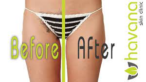 The results of treatment begin soon after the very first appointment. Laser Hair Removal Bikini Before After Youtube