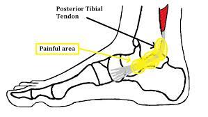 Check spelling or type a new query. Posterior Tibial Tendon Dysfunction Experts In Ankle Pain