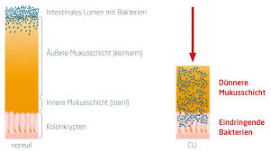 Colitis Ulcerosa Ursachen Symptome Und Behandlung