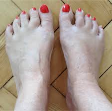 Midfoot Arthritis Foot Swelling The London Foot Ankle Clinic Midfoot Arthritis Arthritis Arthritis Relief