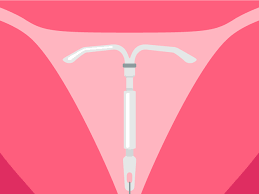 This hormone thickens the mucus in the cervix to trap and block sperm, it can also prevent the eggs from leaving your ovaries. Iud Removal Ob Gyn Experts Explain What To Expect Self