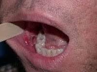 Recognize the early warning signs of oral cancer and understand what activities put you at higher what are the early signs and symptoms of mouth cancer? Be Aware Of Early Signs Of Mouth Cancer And Remedial Measures Steemit