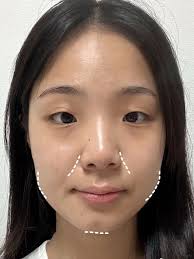 漂亮下巴好像有點內縮