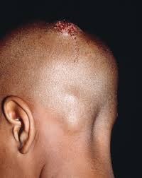 Image result for Tinea Capitis