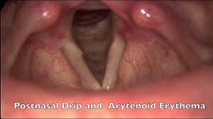 Image result for Reflux Laryngitis