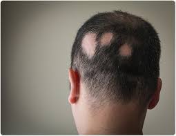 alopecia and acupuncture treatment