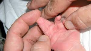 Lifestyle changes, such as avoiding foods high in sodium and. Webbing Of The Fingers Causes And Treatments