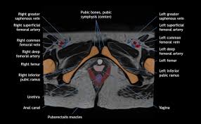 Jul 15, 2020 · peripheral nerve tumors are growths in or near the strands of tissue (nerves) that transmit signals from your brain to the rest of your body. Casestacks Com Pelvic Anatomy On Mri