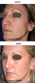 La décision d'une intervention doit être mûrement réfléchie et ne doit se faire sur un coup de tête. Conseils Avant Et Apres La Rhinoplastie