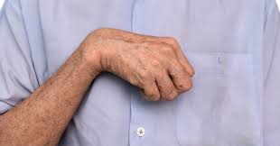 Image result for Chorea