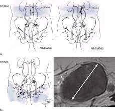 Staging of advanced ovarian cancer: Tnm And Figo Staging Systems For Ovarian Cancer Take Into Account The Download Scientific Diagram