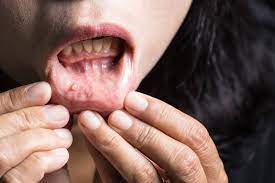 Throat cancer involves the development of malignancies of the throat (pharynx), voice box (larynx) and tonsils. Mouth Throat Cancer Detecting Early Stages Of Oral Cancer