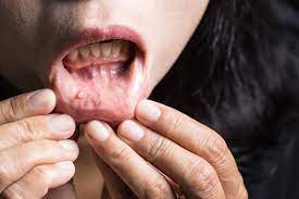 The national cancer institute (nci) classify throat cancer as a head and neck cancer. Mouth Throat Cancer Detecting Early Stages Of Oral Cancer