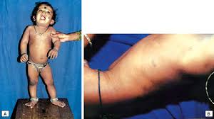Image result for Urticaria pigmentosa children