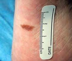 Image result for Acral lentiginous melanoma nail