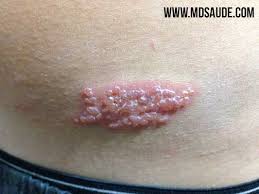 Image result for herpes zoster