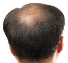 It discusses the benefits of homeopathic hair loss treatment over allopathic or surgical options. Dr Batra S Hair Loss Treatment Styles At Life