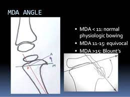 Blount Disease Vs Rickets Blount S Disease