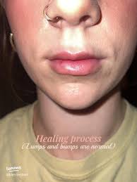 38 top Tear Trough Filler ideas in 2025