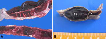 A Hemorrhage On Mucosa And Obstruction Due To Completely Filled With Download Scientific Diagram