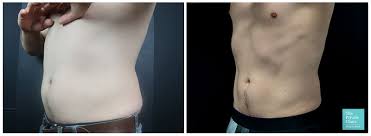 Rosalyn george, wilmington dermatology center. Does Coolsculpting Work Before And After Coolsculpting Fat Freezing Procedure