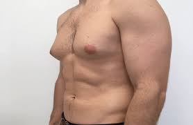 Breast expansion v3 + reduction. Breast Expansion Symptoms Causes Gynecomastia Best Guide 2020