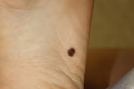 Roving immune cells called t cells can latch on to these neoantigens when they pass by. Melanoma Cancer Therapy Advisor