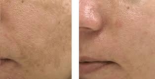 جهاز سبكترا ليزر Spectra Laser فوائده و اضراره و تجاربه و اسعاره جميلة دليل الليزر المنزلي