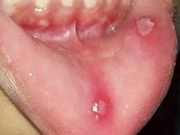 Saya dulu selalu jugak jadi. Tips Merawat Ulser