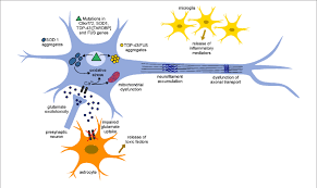Als, or amyotrophic lateral sclerosis, is a progressive neurodegenerative disease that affects nerve cells in the brain and the spinal cord. Pathogenetic Mechanisms Involved In Amyotrophic Lateral Sclerosis Download Scientific Diagram
