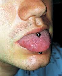 How to clean tongue piercing. Figure Haemophilus Aphrophilus Endocarditis After Tongue Piercing Volume 8 Number 8 August 2002 Emerging Infectious Diseases Journal Cdc