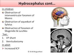 Tmt Vp Shunt Venriculostomy Https Www Slideshare Net Mgmcri1234 Lateral Ventricle Of Brain By Drnmu Medical College Associate Professor Vp Shunt