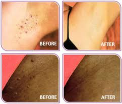 This treatment for ingrown hair is formulated to clean out pores, replenish moisture, soothe, and prevent future ingrown hairs. Ingrown Hair Why Do I Get Ingrown Hairs After Waxing