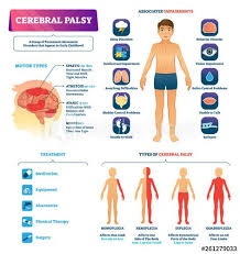 Cerebral Palsy Vector Illustration Permanent Movement Disorder Type Scheme In 2020 Cerebral Palsy What Is Cerebral Palsy Cerebral Palsy Treatment
