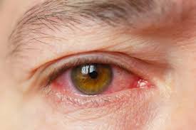 Image result for Bacterial Conjunctivitis
