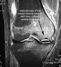 The changes were frequently bilateral, but were not. Pin On Bones