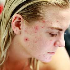 How To Get Rid Of Teenage Spots And Acne In 3 Simple Steps Bellatory