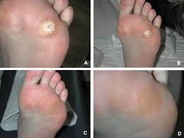 Maybe you would like to learn more about one of these? How To Treat Plantar Warts Treating Your Sole