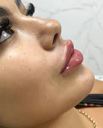 Será que 1 ml faz diferença no preenchimento labial? Muita gente tem essa  dúvida, mas sim, 1ml pode fazer uma diferença significativa no  preenchimento labial, e o verdadeiro diferencial está em utilizar