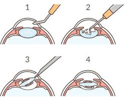 Image result for Cataract Extraction