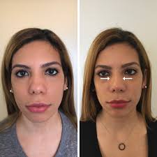 With The Non Surgical Nose Job One Of The Many Things You Can Do Is Create A Bridge Of The Nose Where The Bridge Is Nose Job Nose Fillers Nonsurgical Nose Job